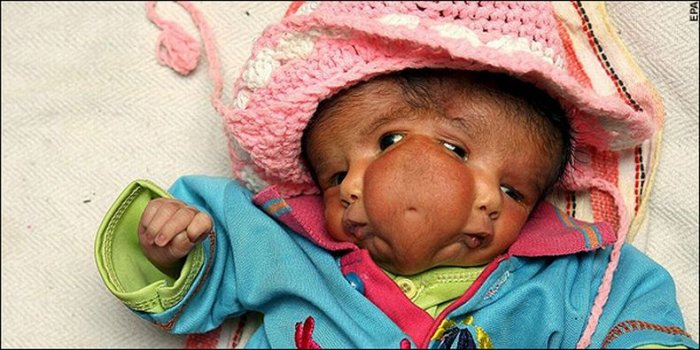 В Индии родилась девочка с двумя лицами (4 фото)