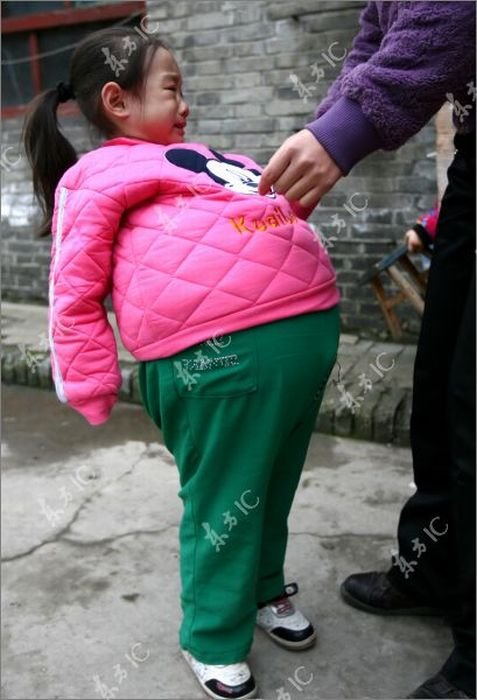 Девочка с огромным животом (19 фото)