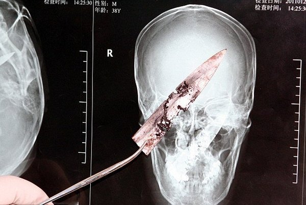 Китаец жил 4 года с ножом в голове (3 фото + текст)