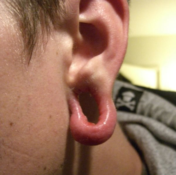 Последствия туннелей в ушах (10 фото)