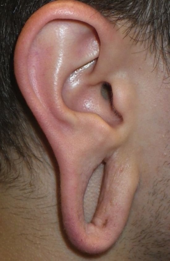 Последствия туннелей в ушах (10 фото)