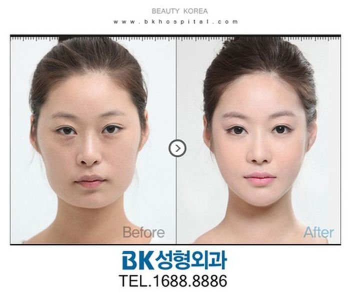 Пластическая хирургия в корее до и после фото