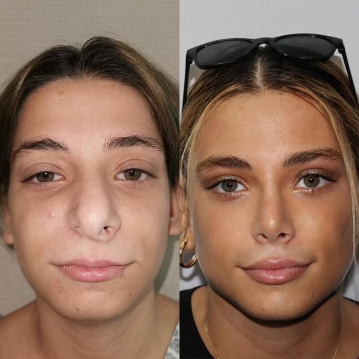 До и после пластической операции