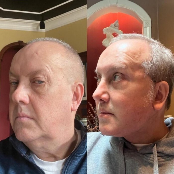 До и после пластической операции