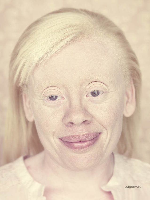 Как люди рождаются альбиносами. Глазно-кожный альбинизм. Альбиносы люди.
